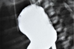 atresia-esofago-dehiscencia-sutura-derrame-contraste-mediastino-pleura-5d-17d-1m-1992-001