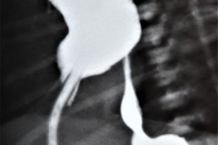 atresia-esofago-dehiscencia-sutura-derrame-contraste-mediastino-pleura-5d-17d-1m-1992-002