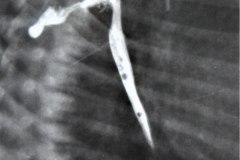 atresia-esofago-dehiscencia-sutura-derrame-contraste-mediastino-pleura-5d-17d-1m-1992-005