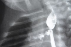 atresia-esofago-dehiscencia-sutura-derrame-contraste-mediastino-pleura-5d-17d-1m-1992-007