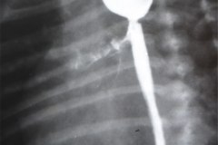 atresia-esofago-dehiscencia-sutura-derrame-contraste-mediastino-pleura-5d-17d-1m-1992-008
