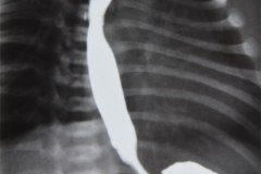 atresia-esofago-diverticulo-esofagico-postop-1997-003