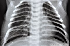atresia-esofago-diverticulo-esofagico-postop-1997-006