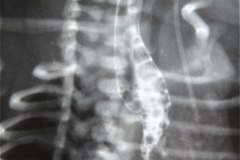 atresia-esofago-esofagograma-raquisquisis-t10-1992-001