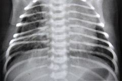 atresia-esofago-esofagograma-raquisquisis-t10-1992-002