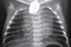 atresia-esofago-esofagograma-raquisquisis-t10-1992-003