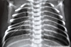 atresia-esofago-esofagograma-raquisquisis-t10-1992-004
