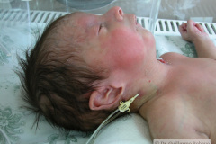 atresia-esofago-esofagostomia-gastrostomia-paralisis-facial-cateter-yugular-2002-000