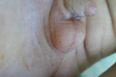 atresia-esofago-esofagostomia-gastrostomia-paralisis-facial-cateter-yugular-2002-002