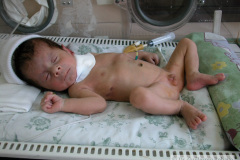 atresia-esofago-esofagostomia-gastrostomia-paralisis-facial-cateter-yugular-2002-005