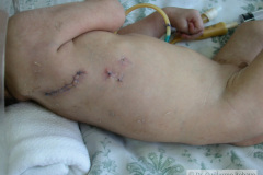 atresia-esofago-esofagostomia-gastrostomia-paralisis-facial-cateter-yugular-2002-009