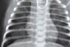 atresia-esofago-fistula-traqueoesofagica-1987-000
