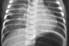 atresia-esofago-fistula-traqueoesofagica-broncoaspiracion-001