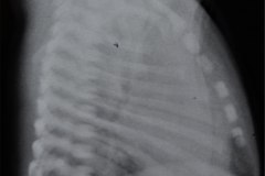 atresia-esofago-fistula-traqueoesofagica-contraste-aire-y-sonda-baritada-enfisema-subcutneo-1993-000