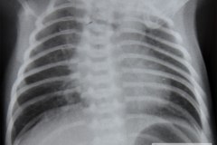 atresia-esofago-fistula-traqueoesofagica-contraste-aire-y-sonda-baritada-enfisema-subcutneo-1993-001
