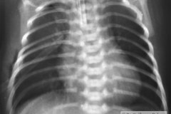 atresia-esofago-fistula-traqueoesofagica-contraste-aire-y-sonda-baritada-enfisema-subcutneo-1993-004
