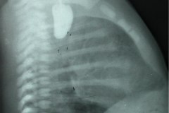 atresia-esofago-fistula-traqueoesofagica-contraste-bario-1984-000