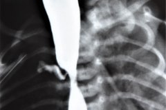 atresia-esofago-fistula-traqueoesofagica-derrame-pleural-quilotorax-dehiscencia-sutura-1997-006