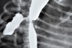 atresia-esofago-fistula-traqueoesofagica-derrame-pleural-quilotorax-dehiscencia-sutura-1997-008