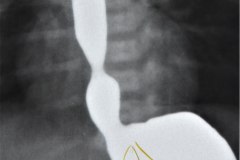 atresia-esofago-fistula-traqueoesofagica-diverticulo-y-reflujo-post-anastomosis-rn8d-1987-001