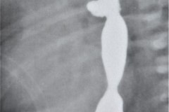 atresia-esofago-fistula-traqueoesofagica-diverticulo-y-reflujo-post-anastomosis-rn8d-1987-002