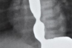 atresia-esofago-fistula-traqueoesofagica-diverticulo-y-reflujo-post-anastomosis-rn8d-1987-004