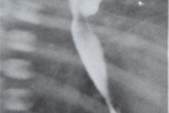 atresia-esofago-fistula-traqueoesofagica-diverticulo-y-reflujo-post-anastomosis-rn8d-1987-005