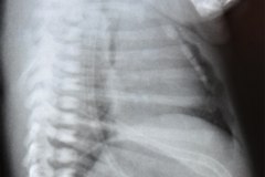 atresia-esofago-fistula-traqueoesofagica-esofagograma-postop-neumotorax-der-hipoplasia-costal-2001-003