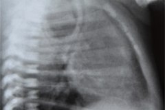atresia-esofago-fistula-traqueoesofagica-esofagograma-postop-neumotorax-der-hipoplasia-costal-2001-004
