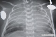 atresia-esofago-fistula-traqueoesofagica-postop-atelctasia-y-enfisema-compensatorio-2m-1994-010