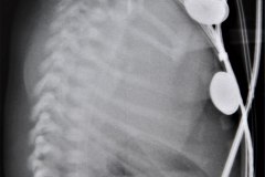 atresia-esofago-fistula-traqueoesofagica-postop-atelctasia-y-enfisema-compensatorio-2m-1994-012