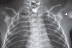 atresia-esofago-iatrogenia-medio-contraste-bario-por-succion-000