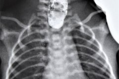 atresia-esofago-iatrogenia-medio-contraste-bario-por-succion-001