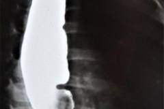 atresia-esofago-interposicion-colon-reflujo-gastroesofagico-postop-2000-001