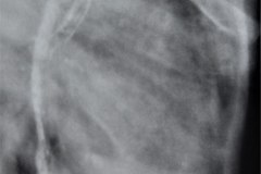 atresia-esofago-refistulizacion-broncograma-bario-derrame-pleural-der-2m-1984-001