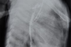 atresia-esofago-refistulizacion-broncograma-bario-derrame-pleural-der-2m-1984-003