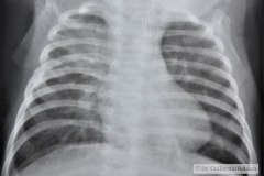 atresia-esofago-refistulizacion-broncograma-bario-derrame-pleural-der-2m-1984-004