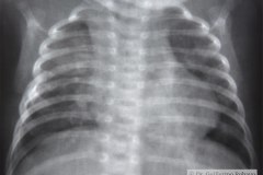 atresia-esofago-refistulizacion-condensacion-apical-der-reflujo-broncograma-bario-1m-2m-3m-6m-1984-000