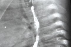 atresia-esofago-refistulizacion-condensacion-apical-der-reflujo-broncograma-bario-1m-2m-3m-6m-1984-001