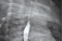 atresia-esofago-refistulizacion-condensacion-apical-der-reflujo-broncograma-bario-1m-2m-3m-6m-1984-002