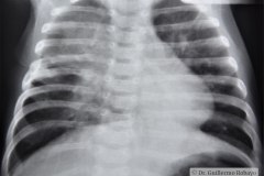 atresia-esofago-refistulizacion-condensacion-apical-der-reflujo-broncograma-bario-1m-2m-3m-6m-1984-003