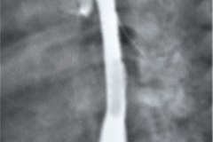 atresia-esofago-refistulizacion-condensacion-apical-der-reflujo-broncograma-bario-1m-2m-3m-6m-1984-004