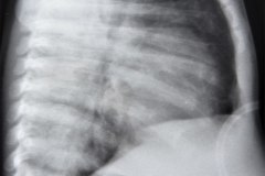 atresia-esofago-refistulizacion-condensacion-apical-der-reflujo-broncograma-bario-1m-2m-3m-6m-1984-005
