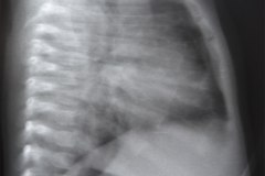 atresia-esofago-refistulizacion-condensacion-apical-der-reflujo-broncograma-bario-1m-2m-3m-6m-1984-006
