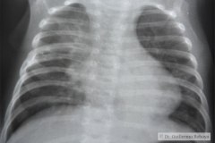 atresia-esofago-refistulizacion-condensacion-apical-der-reflujo-broncograma-bario-1m-2m-3m-6m-1984-007