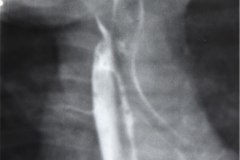 atresia-esofago-refistulizacion-condensacion-apical-der-reflujo-broncograma-bario-1m-2m-3m-6m-1984-008