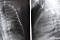 atresia-esofago-refistulizacion-condensacion-apical-der-reflujo-broncograma-bario-1m-2m-3m-6m-1984-009