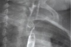 atresia-esofago-refistulizacion-condensacion-apical-der-reflujo-broncograma-bario-1m-2m-3m-6m-1984-010