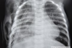 atresia-esofago-refistulizacion-condensacion-apical-der-reflujo-broncograma-bario-1m-2m-3m-6m-1984-011