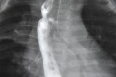 atresia-esofago-refistulizacion-condensacion-apical-der-reflujo-broncograma-bario-1m-2m-3m-6m-1984-012